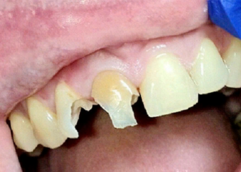 Особенности и правила реставрации разрушенных зубов