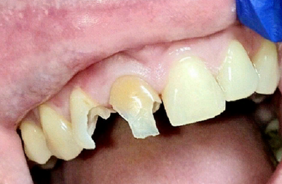 Особенности и правила реставрации разрушенных зубов