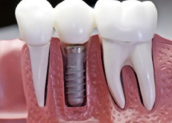 Правила и этапы установки зубов имплантов