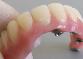 Как правильно выполнить установку коронок в стоматологии