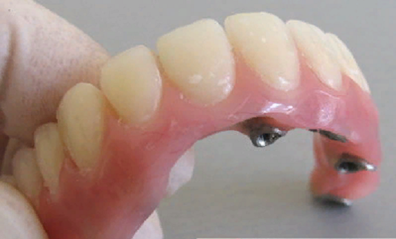 Как правильно выполнить установку коронок в стоматологии