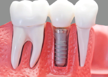 Установка зубных имплантов: правила и основные этапы