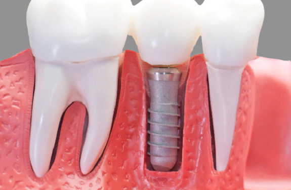 Установка зубных имплантов: правила и основные этапы