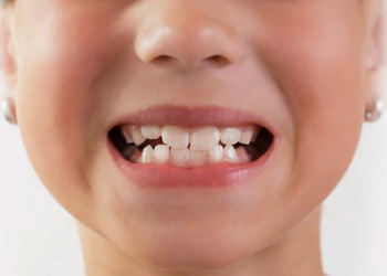 Исправление неправильного прикуса: способы и правила