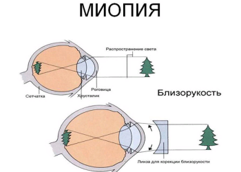 Перші симптоми міопії і її наслідки