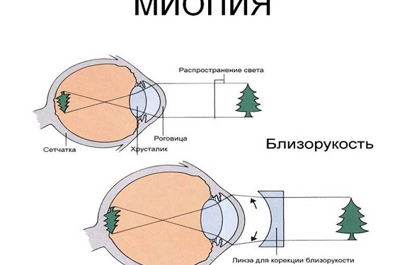 Перші симптоми міопії і її наслідки