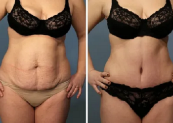 Абдомінопластика чи ні: часті питання до пластичного хірурга