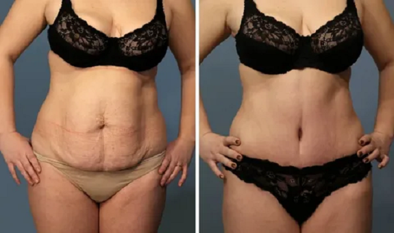 Абдомінопластика чи ні: часті питання до пластичного хірурга