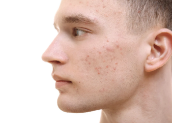Лечение угревой сыпи: правила, способы и советы