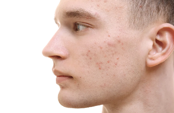 Лечение угревой сыпи: правила, способы и советы