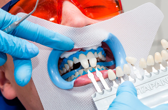 Рекомендации по безопасному отбеливанию зубов в стоматологии