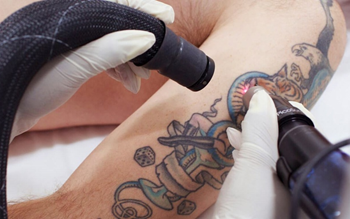 Лазерное удаление татуажа: что нужно знать и советы