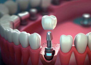 Особенности выравнивания зубов: что нужно знать перед процедурой